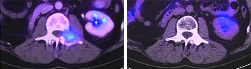 Bildgebung Metastase Verlauf nach CK